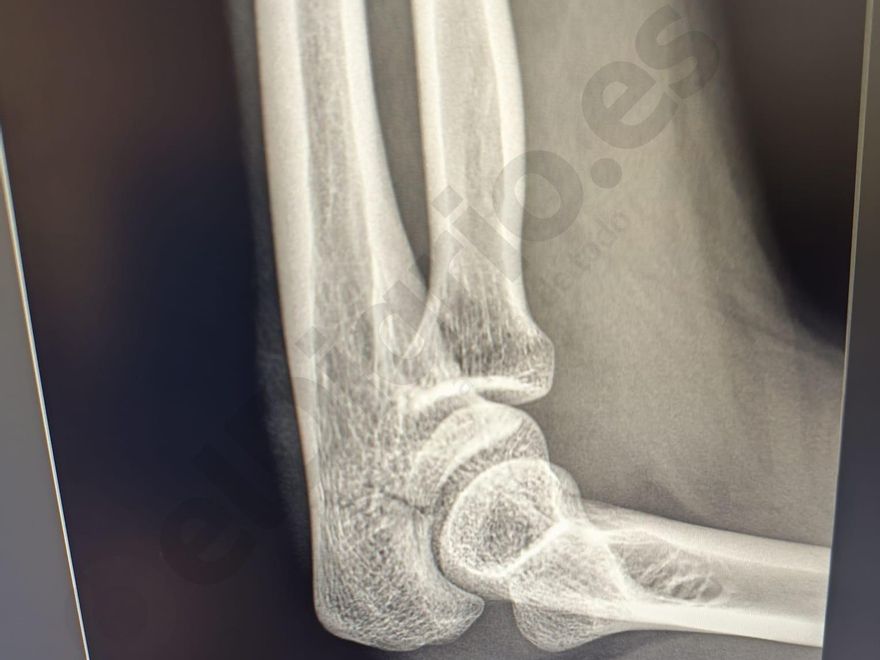 Radiografía de Ainhoa con la fractura del olécranon (cúbito)